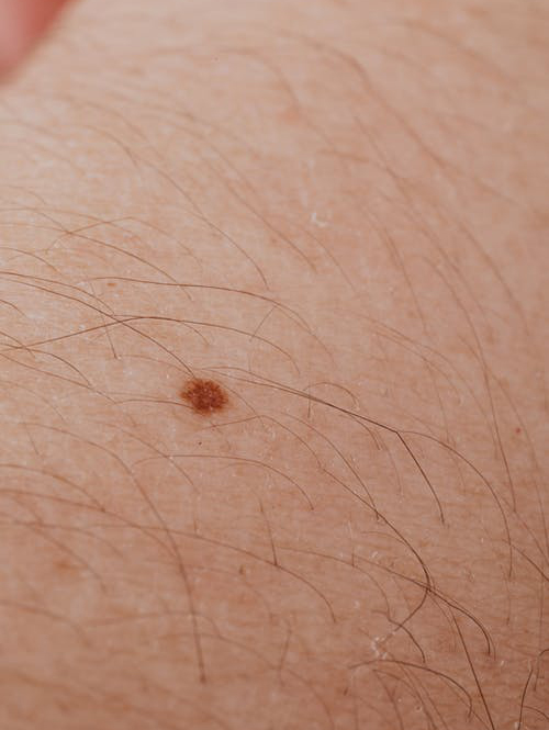 Five Unusual Skin Growths Some That Are Cancerous 